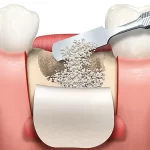 Bone Graft Material: Mempercepat Regenerasi Tulang