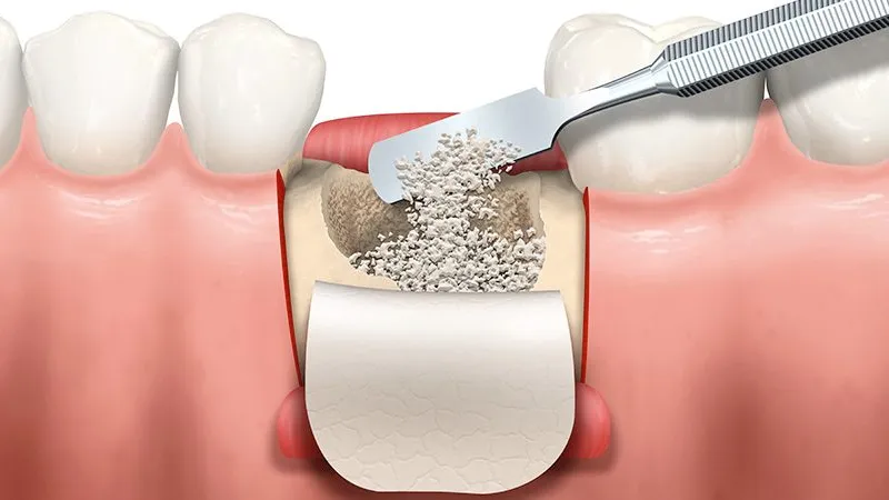 Bone Graft Material: Mempercepat Regenerasi Tulang