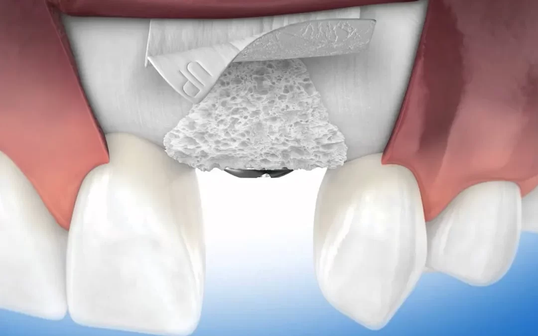 Optimalkan Regenerasi Tulang Gigi dengan Bone Graft dan Batan Bran