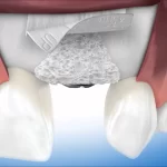 Optimalkan Regenerasi Tulang Gigi dengan Bone Graft dan Batan Bran