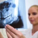 Atasi Resorpsi Tulang! Bone Graft Gigi untuk Memperbaiki Rahang