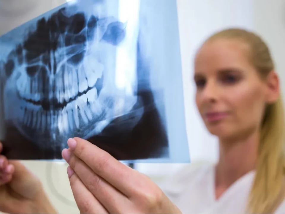 Atasi Resorpsi Tulang! Bone Graft Gigi untuk Memperbaiki Rahang