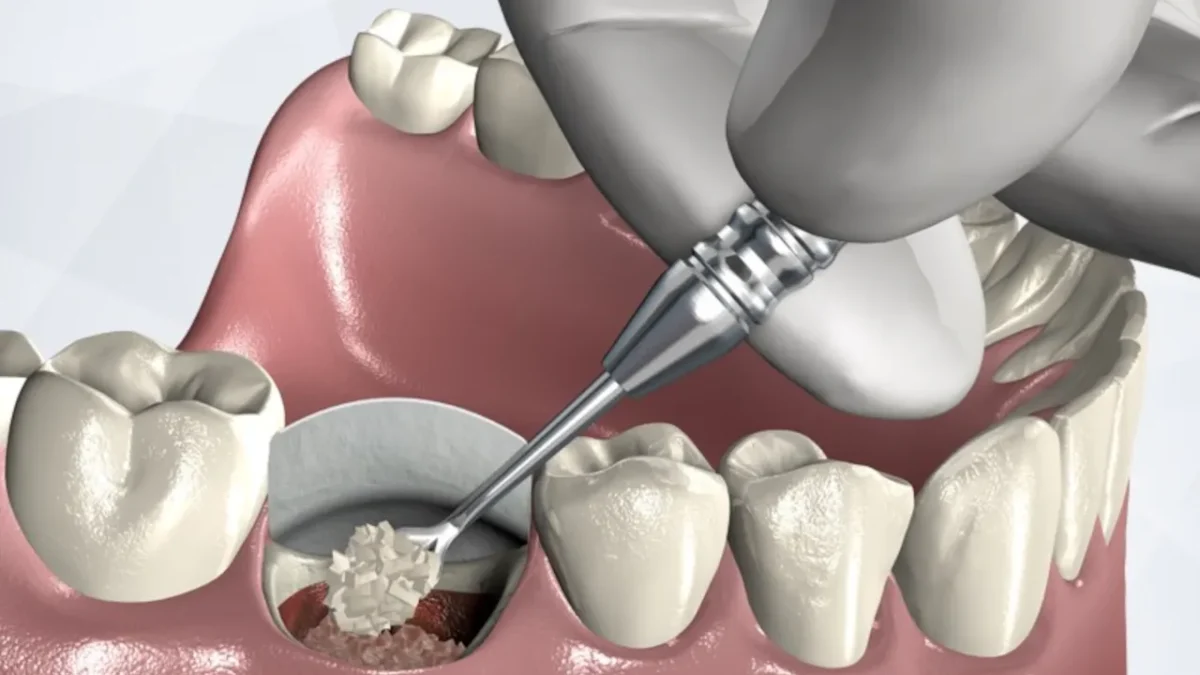 Socket Preservation, Cara Efektif Menjaga Struktur Tulang Alveolar Setelah Cabut Gigi