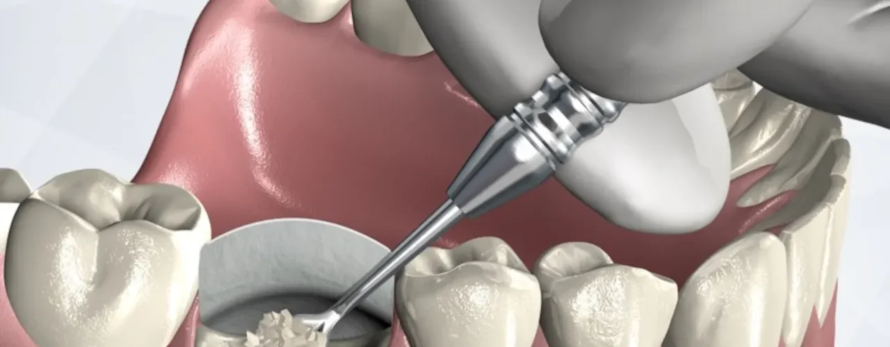 Socket Preservation, Cara Efektif Menjaga Struktur Tulang Alveolar Setelah Cabut Gigi