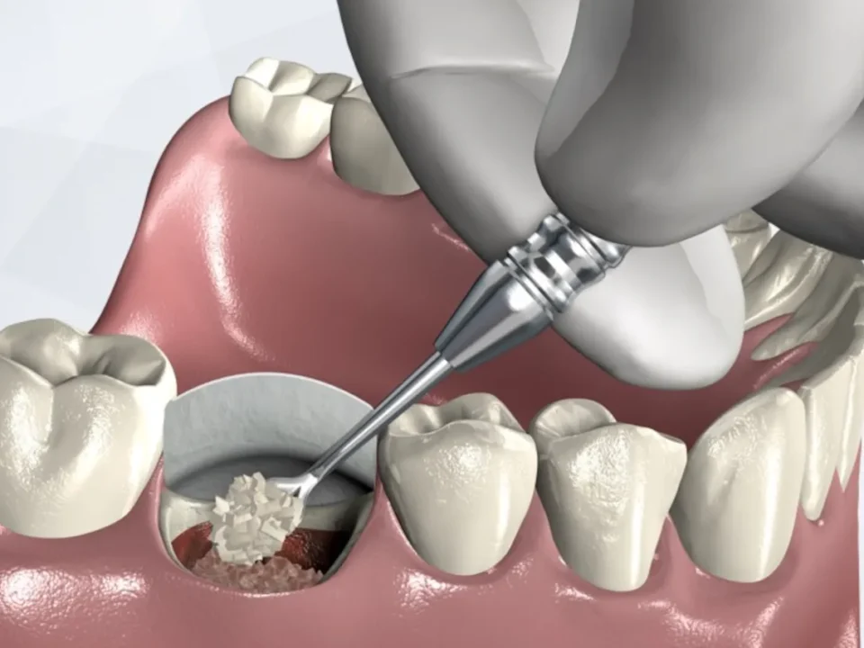 Socket Preservation, Cara Efektif Menjaga Struktur Tulang Alveolar Setelah Cabut Gigi
